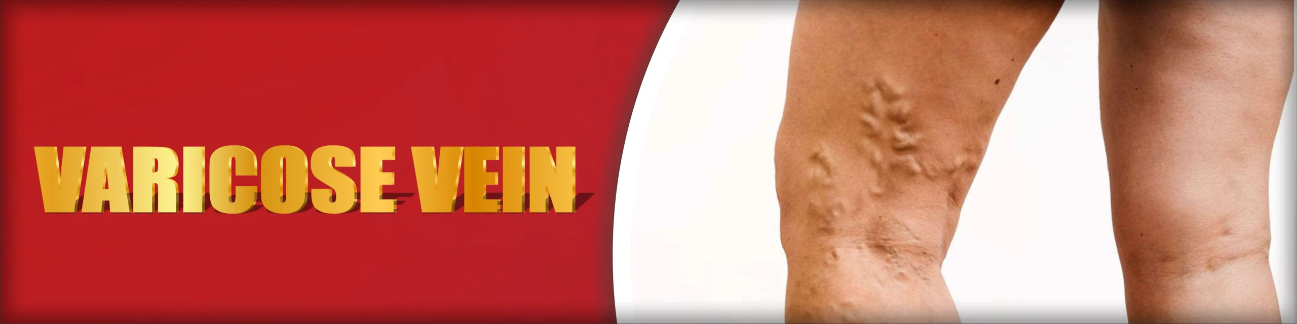 Varicose Vein