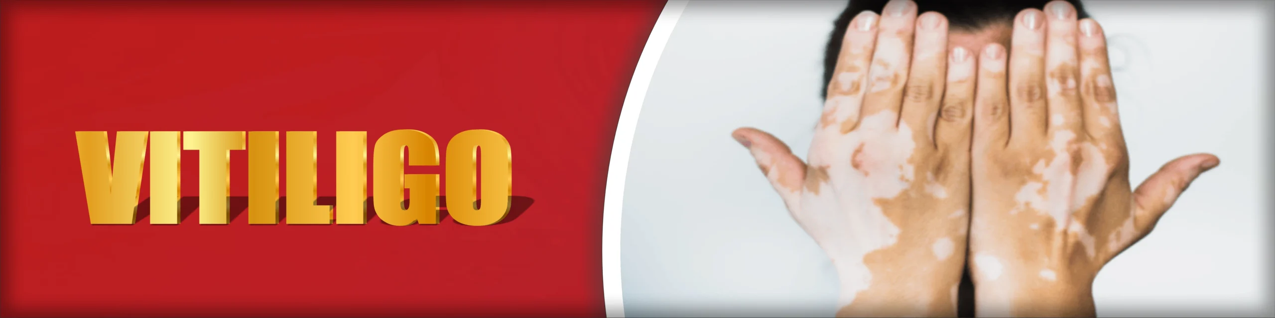 Vitiligo