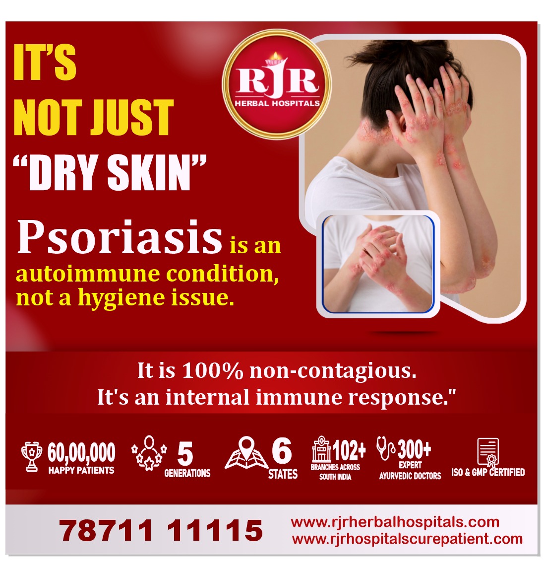It’s Not Just “Dry Skin” – Understanding Psoriasis