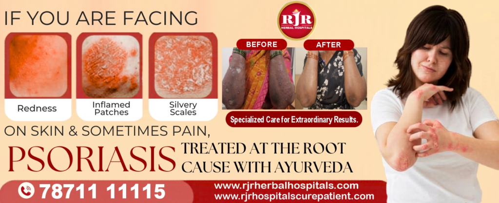 Are You Facing Psoriasis? Treat It Naturally