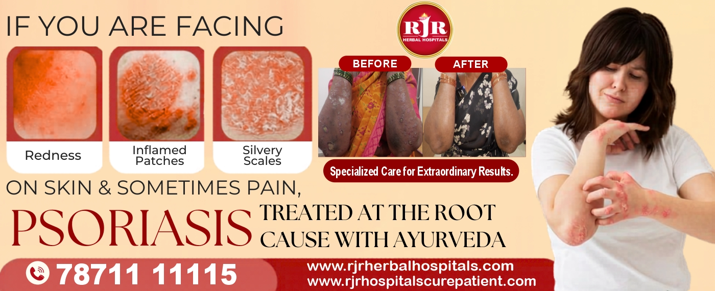 Are You Facing Psoriasis? Treat It Naturally