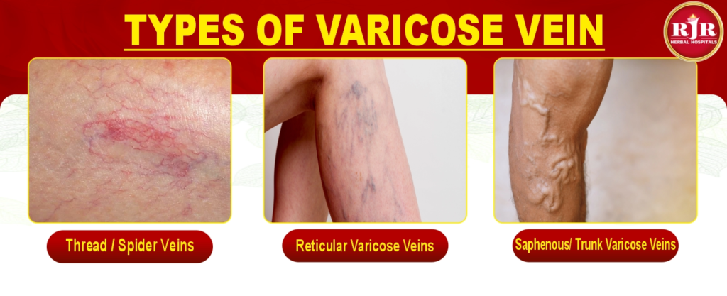 Types of Varicose Veins – Symptoms and Natural Care