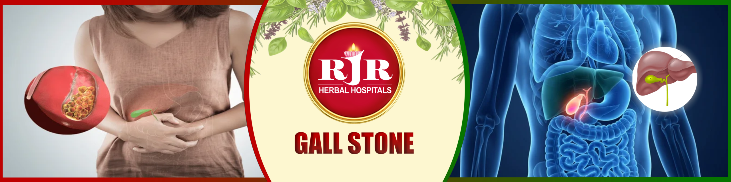 Gallstone