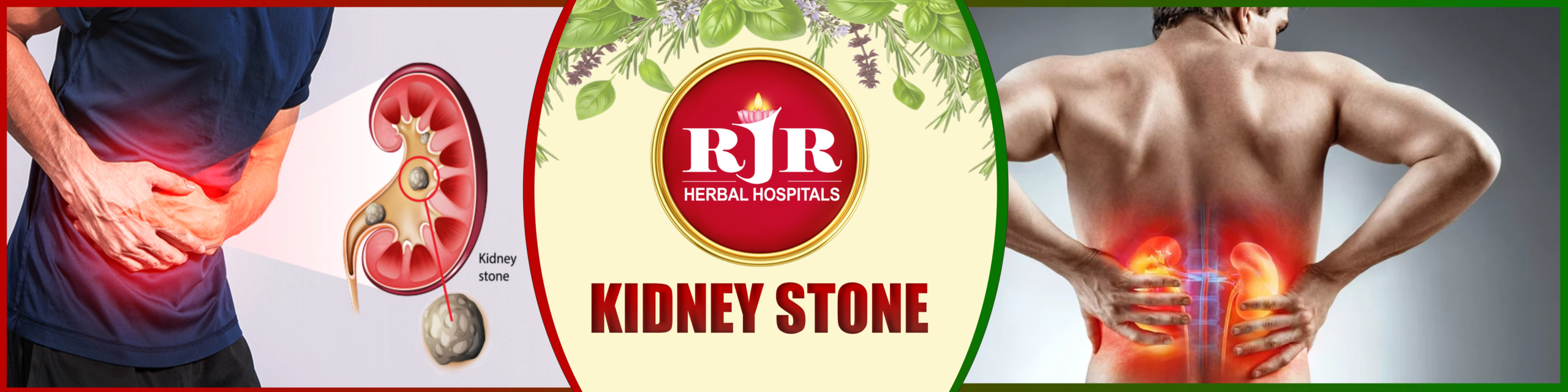 Kidney Stone