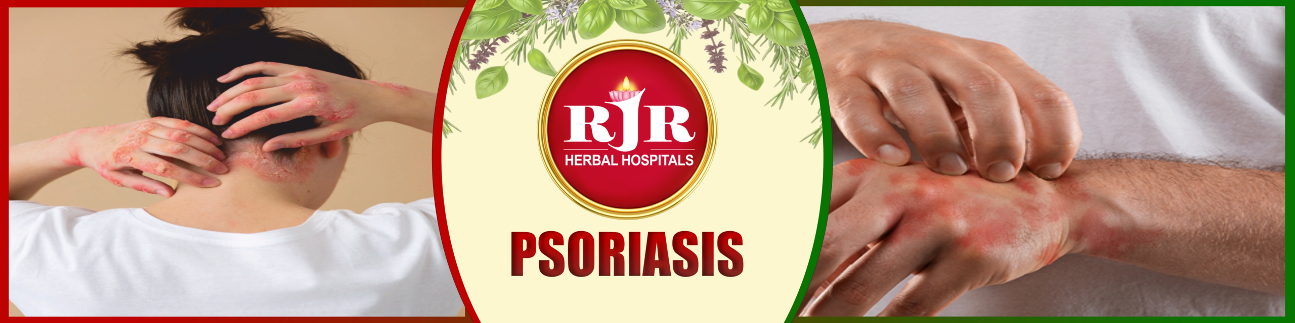 Psoriasis – Marathi