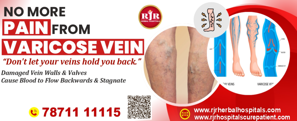 Varicose Veins: Understanding the Causes, Symptoms and Treatment Options