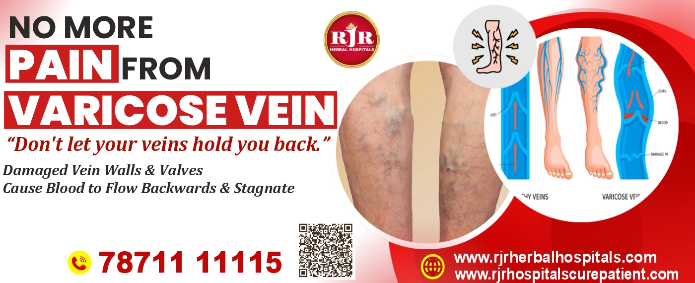 Varicose Veins: Understanding the Causes, Symptoms and Treatment Options